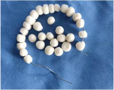 Antibiotic Cement Beads